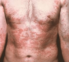 Is comhartha de láithreacht paraisítí é craiceann fadhbach