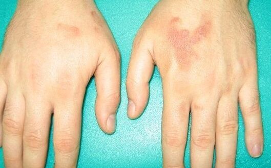 d'fhéadfadh pian i joints na lámha a bheith ina hairíonna de paraisítí