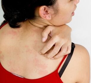 granulomas ar an gcomhlacht - comharthaí láithreacht paraisítí