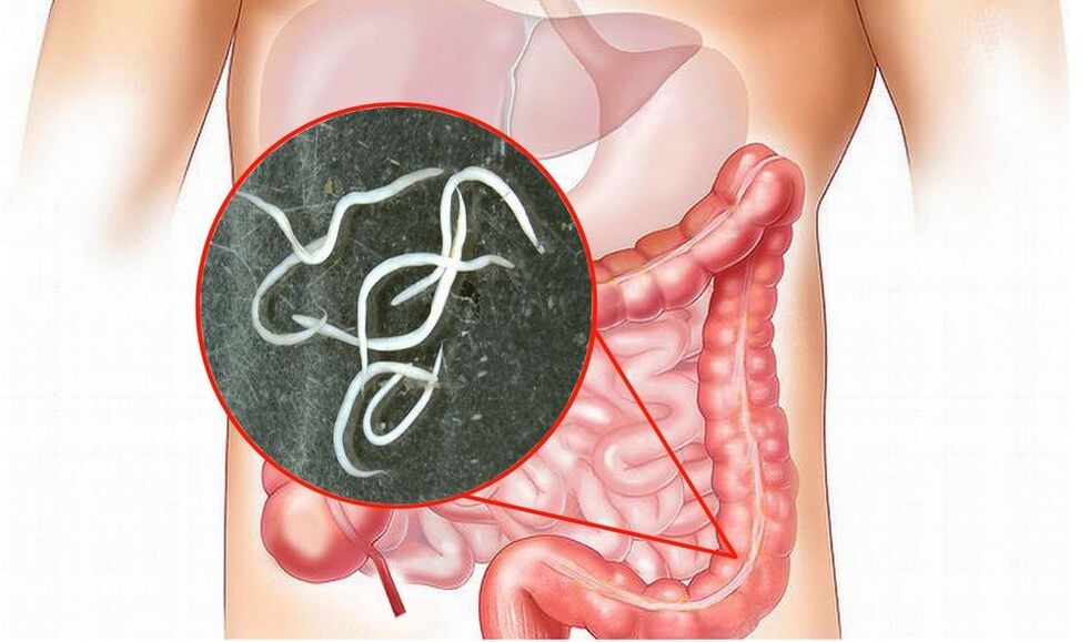 péisteanna sna intestines